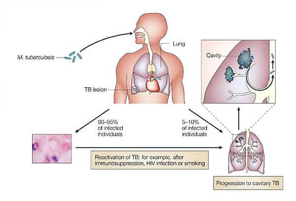 Как можно заразиться туберкулезом легких - как заражаются, как можно заболеть от больного человека, заражение чаще всего возможно на улице