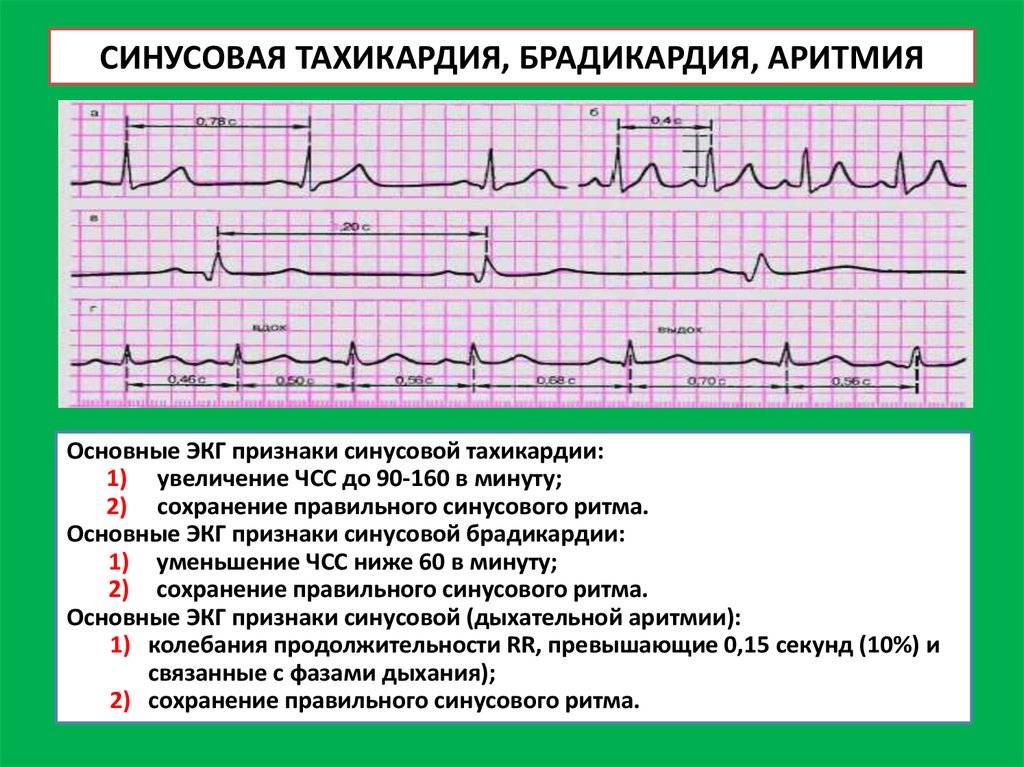 Синусовая брадикардия сердца вертикальное положение эос - врачебный метод