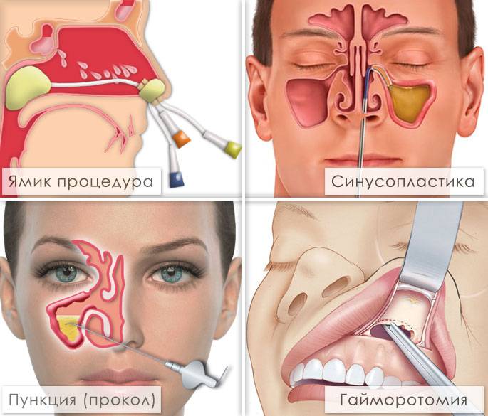 Клиновидная пазуха носа - симптомы воспаления, лечение сфеноидита в домашних условиях без операции, как лечить если открывается