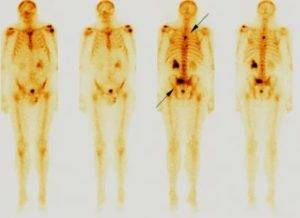 Остеосцинтиграфия или сцинтиграфия скелета. диагностика рака костей и других заболеваний.