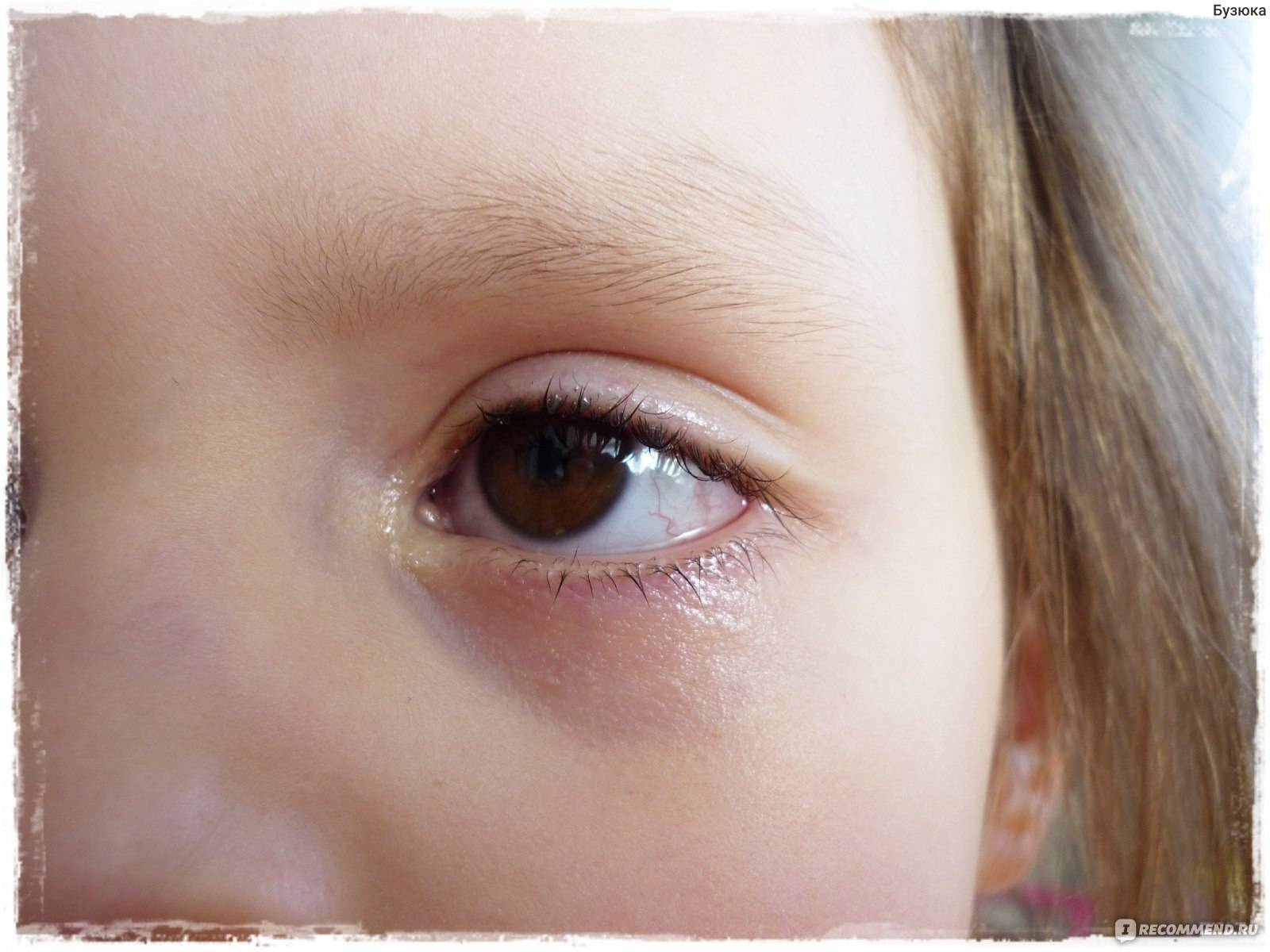 Комаровский о лечении бактериального конъюнктивита глаз у ребенка каплями