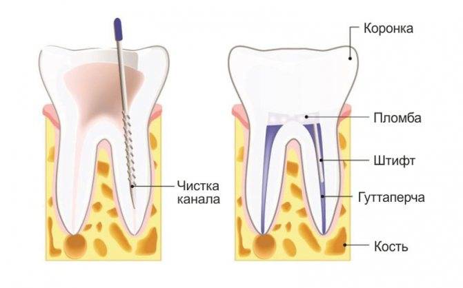 Депульпирование зуба при протезировании: показания к процедуре