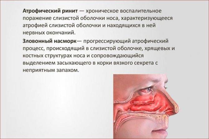 Лечение корок в носу