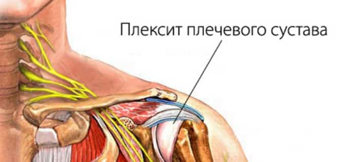 Нейропатия и плексопатия плечевого сплетения лечение - доктор горбунов