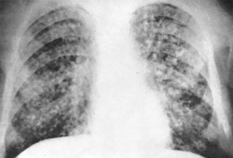 Внелегочный туберкулез