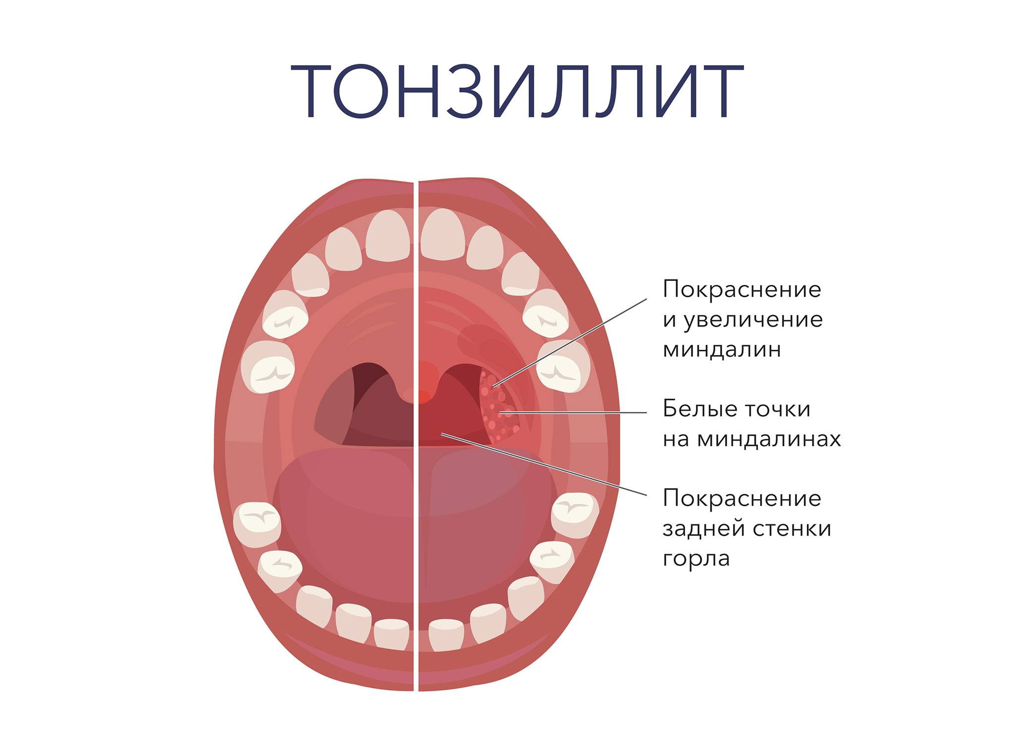 Симптомы гранулезного фарингита с фото горла, причины развития и способы лечения
