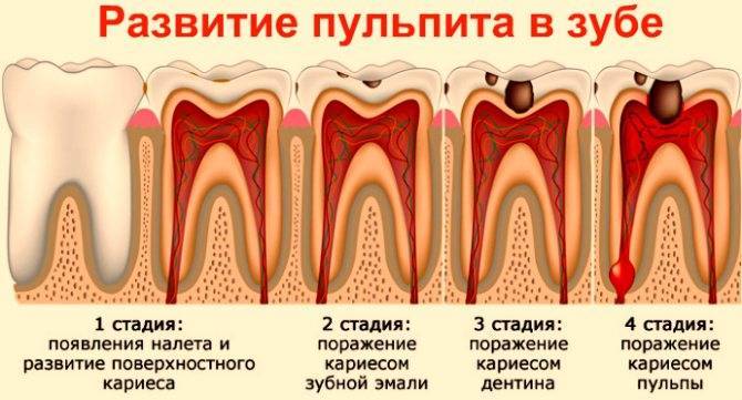Депульпирование зуба – цена и особенности удаления нерва