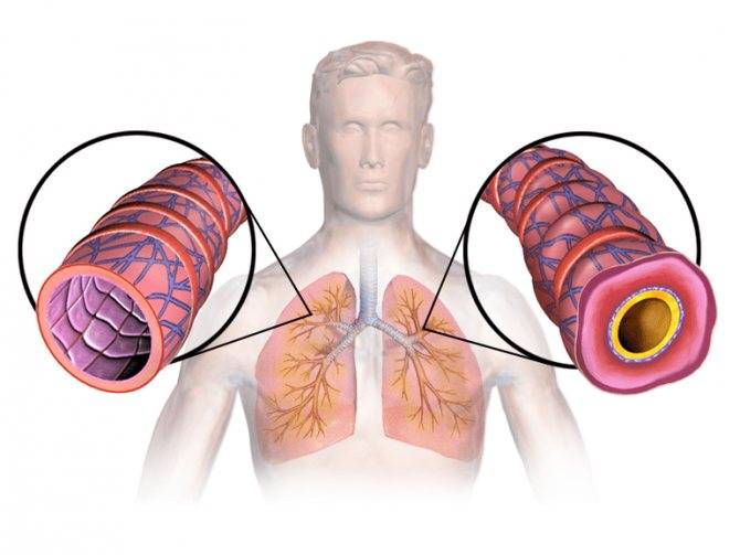 Бронхиальная астма у детей — лечение народными средствами, травами и отварами