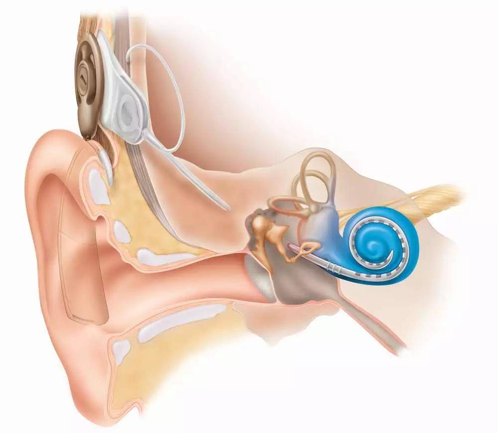 Нейросенсорная тугоухость (сенсоневральная) – симптомы и лечение. лечится или нет нейросенсорная потеря слуха?