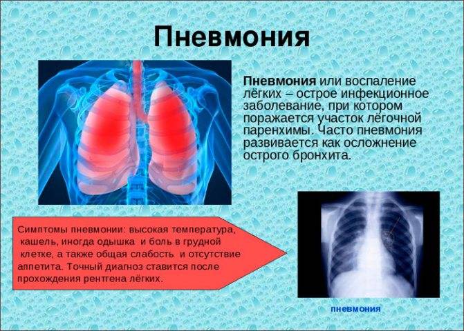 Пневмония - симптомы и лечение, причины воспаления легких, в чем разница, катаральная