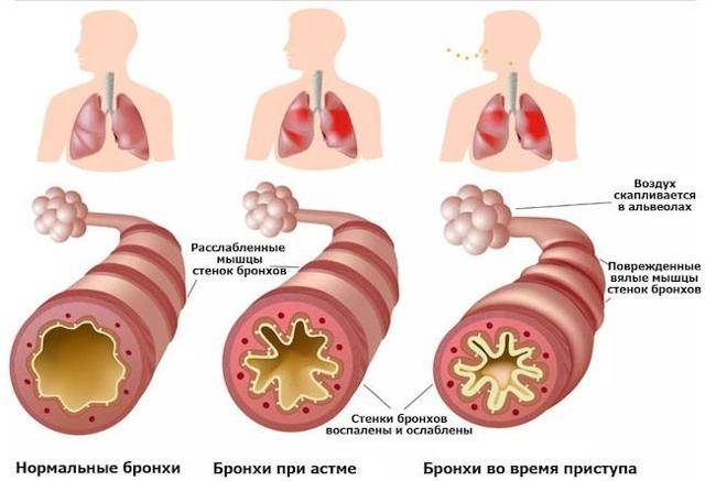Признаки бронхиальной астмы. кашлевая форма у взрослых