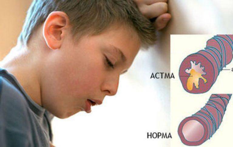 Аллергическая бронхиальная астма. что это и как справляться с недугом?