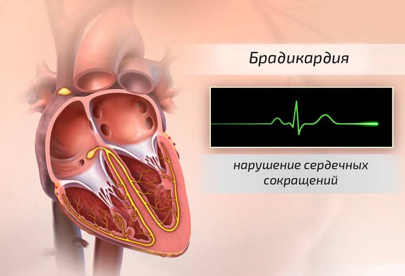 Брадикардия сердца - что это такое? симптомы и лечение болезни