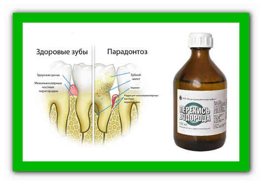 Пародонтоз лечение в домашних условиях перекисью водорода и содой - med-dentall.ru