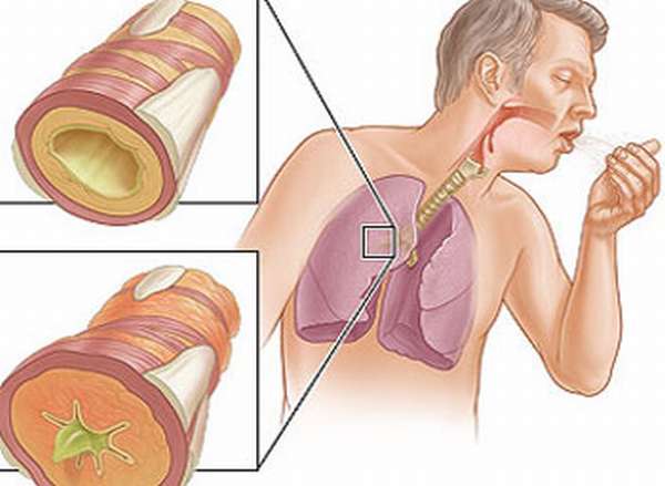 Кашлевая форма экзогенной, эндогенной и смешанной бронхиальной астмы