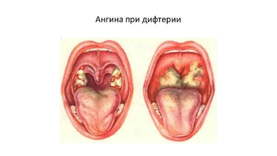 Что такое язвенно-некротическая ангина симановского и как ее лечат? — чтобы горло не болело