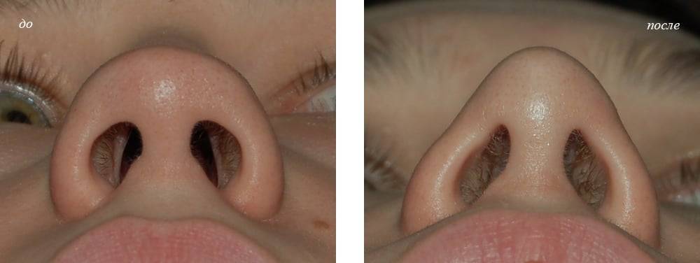 Полипы в носу: симптомы и лечение. причины и методы терапии
