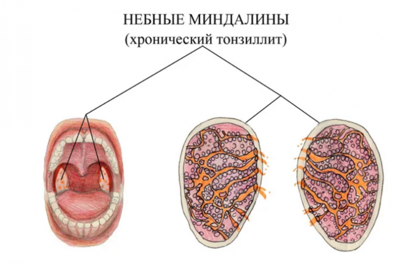Растворы для полоскания горла при тонзиллите
