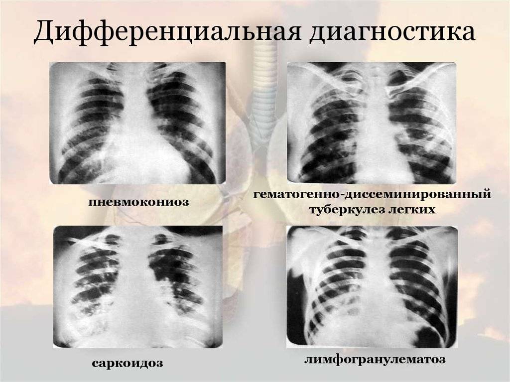 Туберкулёз внелёгочной локализации: причины, симптомы, диагностика, лечение | компетентно о здоровье на ilive