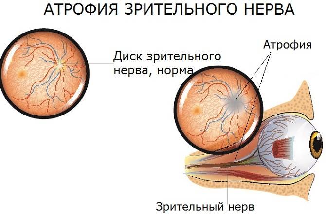 Атрофия зрительного нерва | симптомы и лечение атрофии зрительного нерва | компетентно о здоровье на ilive