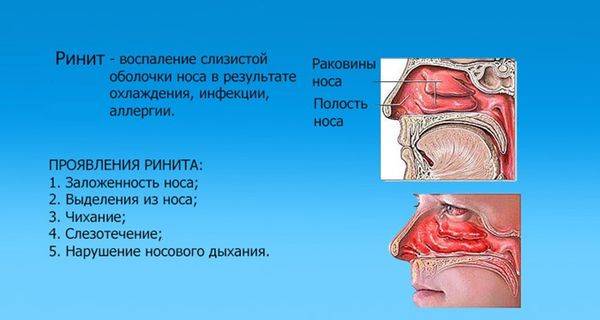 Заложенность носа без насморка - причины и лечение если закладывает и плохо дышит, постоянно заложен без соплей, что делать при постоянной