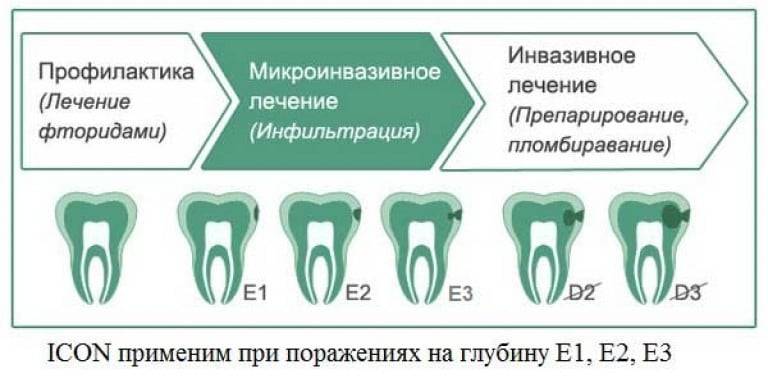 Опасный пришеечный кариес: лечение или как избежать полного разрушения зуба