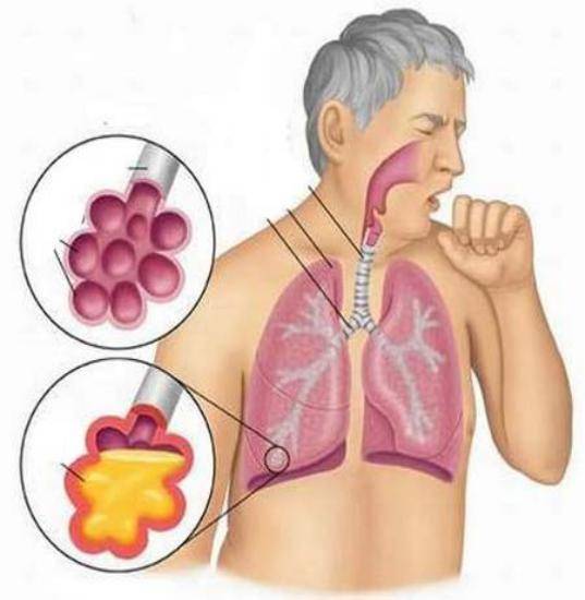 Атипичная пневмония – симптомы у взрослых всех видов особого воспаления легких