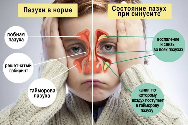 Риносинусит у детей: симптомы, лечение, рекомендации pulmono.ru
