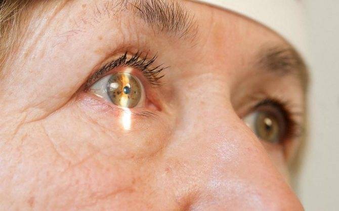 Народные способы лечения катаракты: самые действенные рецепты