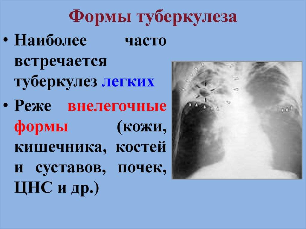 Формы туберкулеза симптомы и признаки