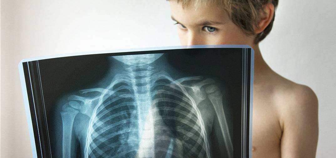 Признаки туберкулеза на ранних стадиях у детей.