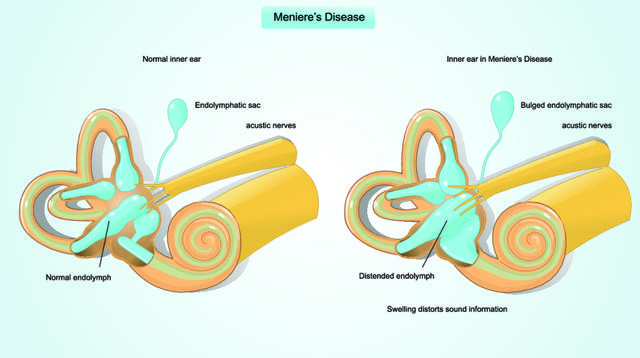 Болезнь меньера: симптомы, диагностика и лечение