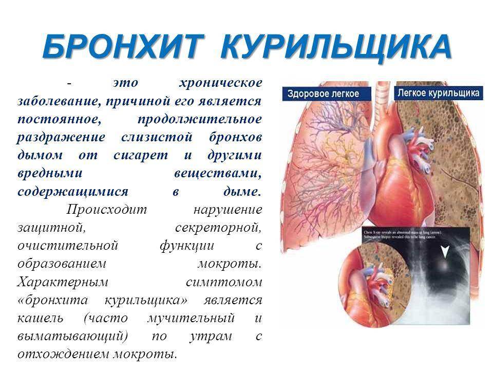 Таблетки от кашля курильщика: наиболее эффективные и недорогие препараты от недуга