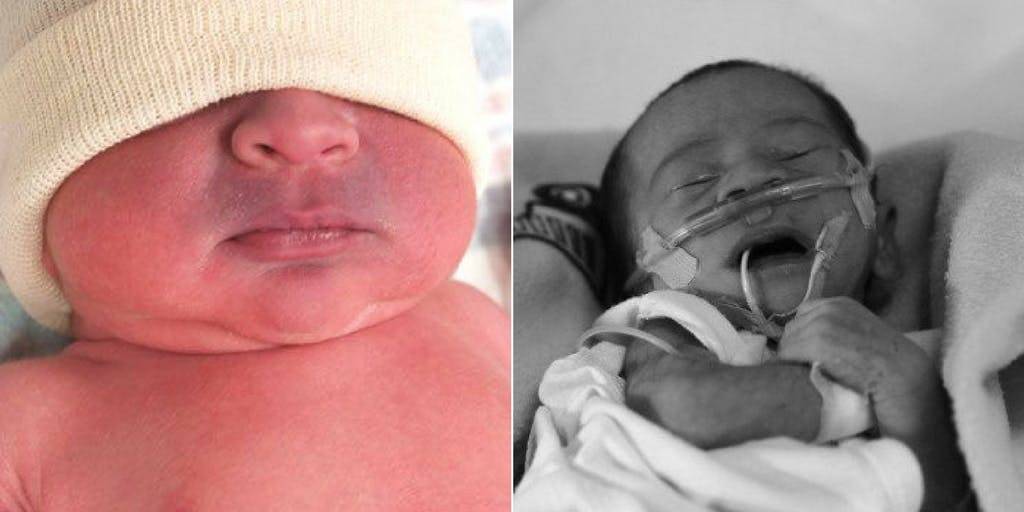 Врождённая пневмония у новорождённых: причины и последствия