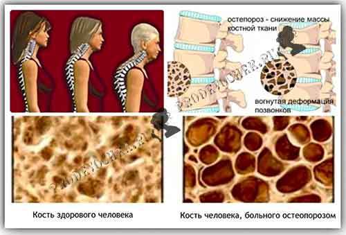 Остеопороз — симптомы и лечение, полное описание заболевания