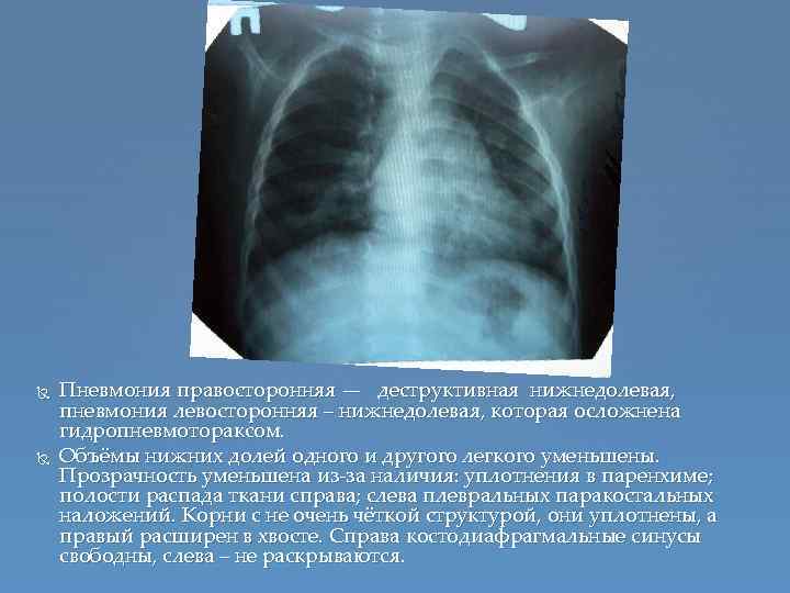 Правосторонняя пневмония: первые симптомы, лечение, профилактика