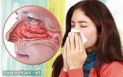 Чем безопасно вылечить заложенность носа при беременности - острый простудный ринит. аллергический ринит. ринит беременных