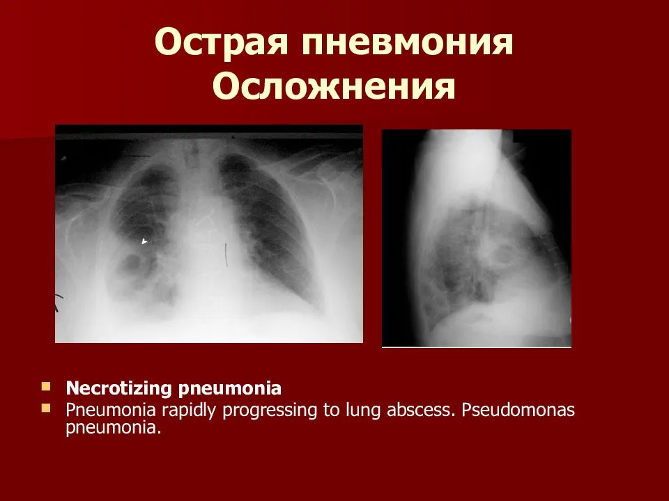 Последствия пневмонии у взрослых и осложнения после лечения