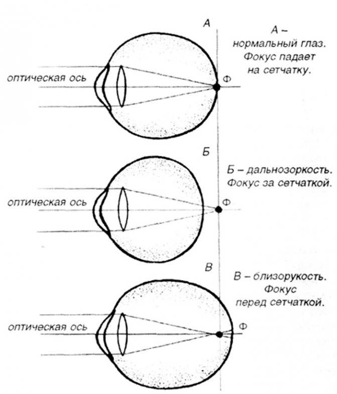 Что такое гиперметропия слабой степени и как её лечить oculistic.ru
что такое гиперметропия слабой степени и как её лечить