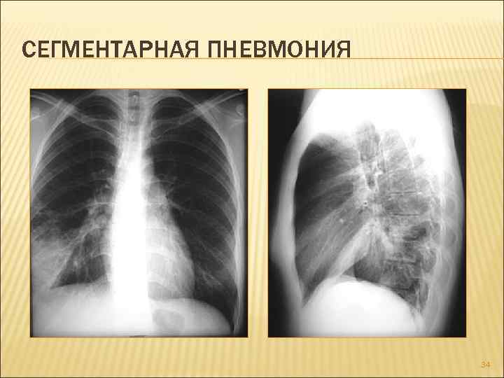 Двусторонняя полисегментарная пневмония причины, методы лечения и профилактика - о болезнях