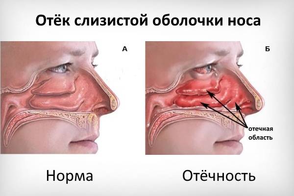 Отек носа без насморка: причины и лечение у взрослых и детей