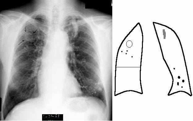 Диссеминированный туберкулёз лёгких код по мкб
