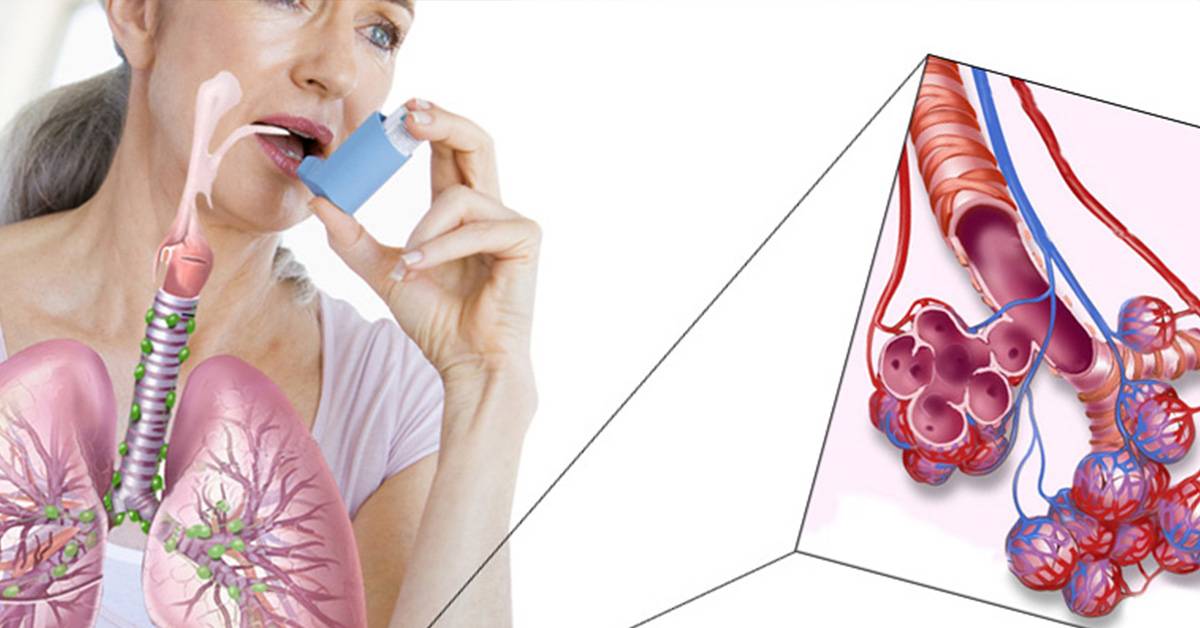 Приступ астмы: симптомы, что делать? как снять приступ больному без лекарств?