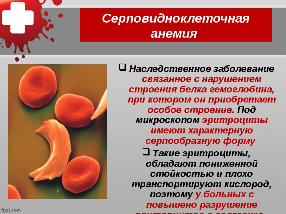 Серповидноклеточная анемия: симптомы, лечение, что это такое
