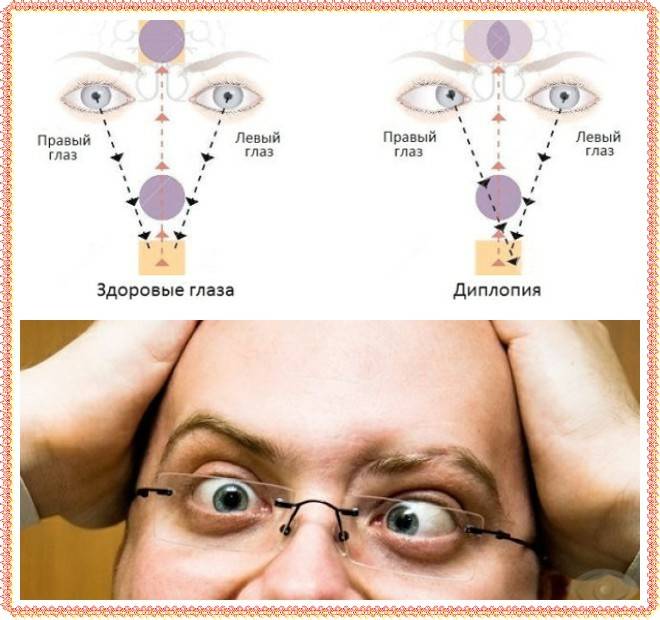 Диплопия глаза: причины, виды, методы лечения и профилактики