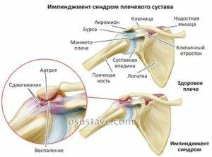 Импинджмент-синдром плечевого сустава: болезнь спортсменов