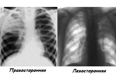 Полисегментарная пневмония двусторонняя - что это бронхопневмония у взрослых, история болезни внебольничной, причины нижнедолевой