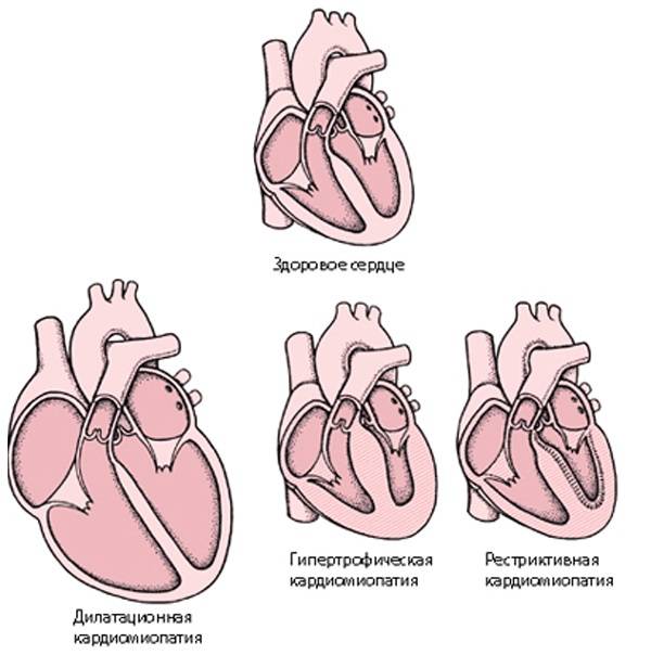 Дилатационная кардиомиопатия: лечение сердца, причины возникновения и прогноз на жизнь