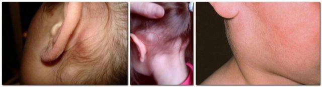 Воспалился лимфоузел за ухом: причины воспаления, что делать и как лечить