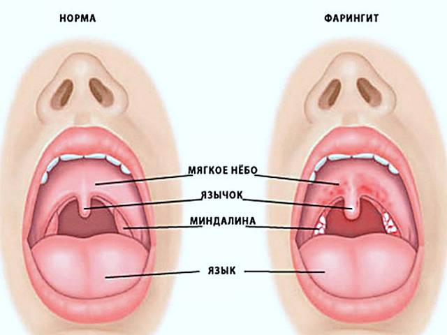 Односторонняя боль в горле при глотании: причины и лечение